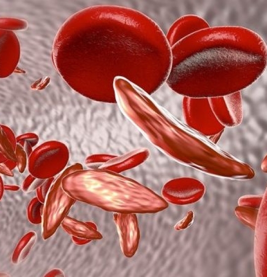 Dia Mundial de Consciência Sobre Anemia Falciforme.