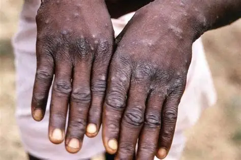 Cabinda regista dois casos confirmados da doença varíola dos macacos