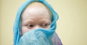 Albinos em Benguela