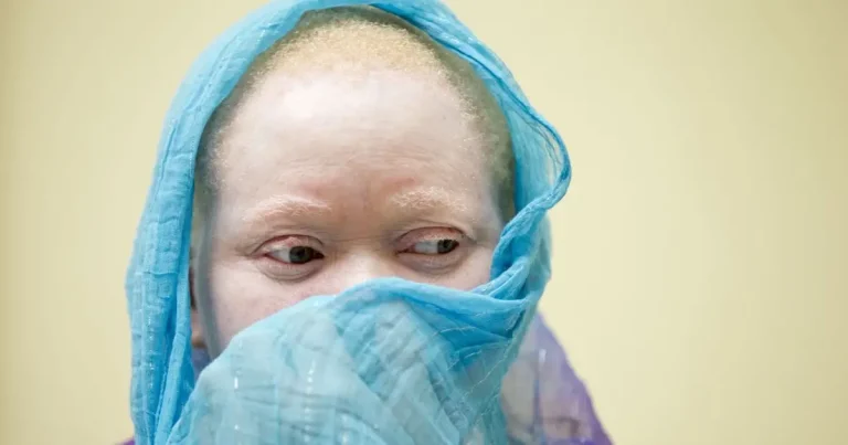 Albinos em Benguela
