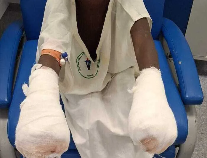 Pai queima mãos dos filhos por suposto furto de 100 kwanzas no Zango 3