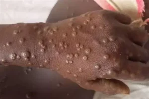 Angola regista 578 casos de Mpox com duas mortes