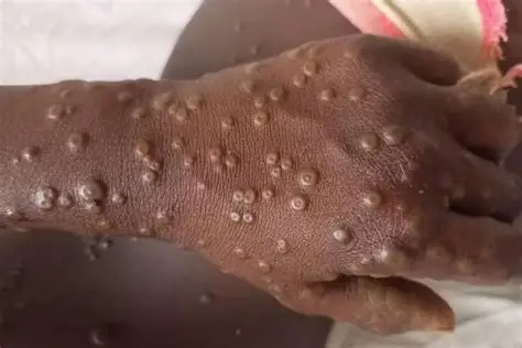 Angola regista 578 casos de Mpox com duas mortes