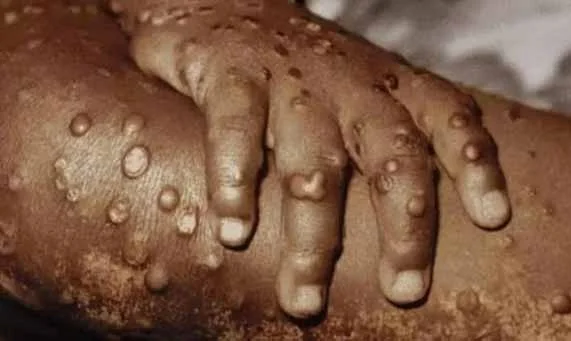 Huambo caso de MPOX.