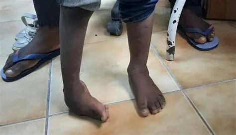 cirurgia correctiva do pé boto